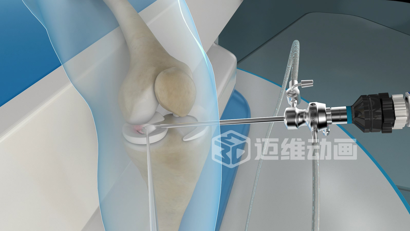 關(guān)節(jié)鏡手術(shù)三維動畫